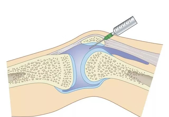 treatment of osteoarthritis.png