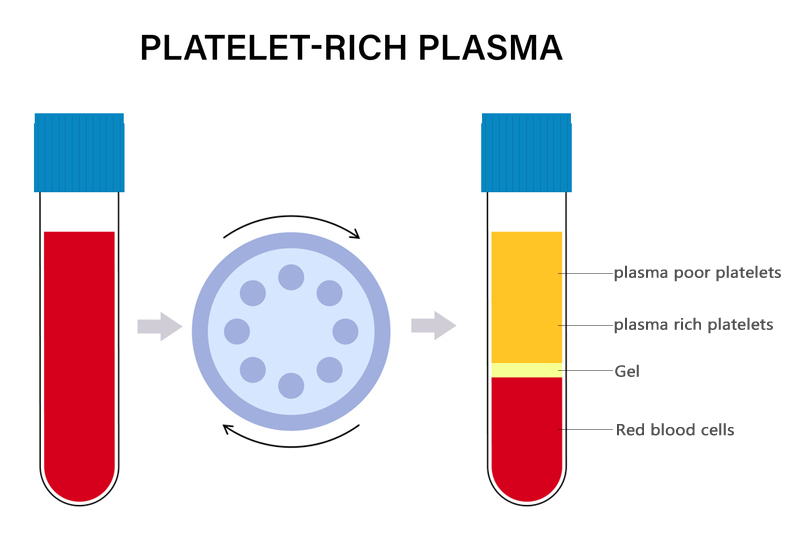 prp centrifugal.jpg